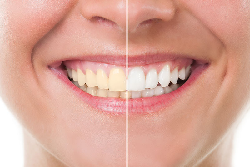 Teeth Whitening in Santa Clara